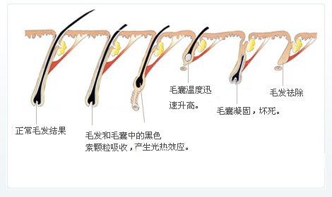 脫毛為什么一次性脫不干凈？原因在這里