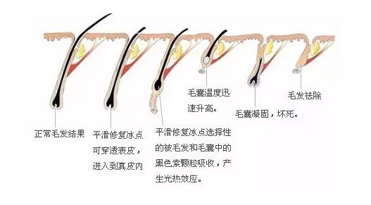 為何OPT脫毛儀能在美容儀器中獨(dú)占鰲頭？