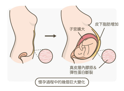 一文秒懂！妊娠紋肥胖紋保養(yǎng)、治療及預(yù)防全攻略