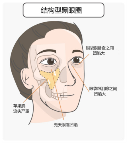區(qū)分黑眼圈！黑眼圈的成因、分類、預(yù)防與治療全攻略