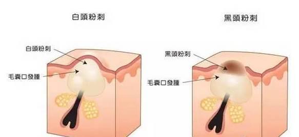 美容儀器廠家教您如何快速祛除黑頭？