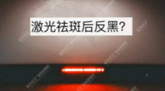 激光祛斑之后皮膚會反黑？美容儀器廠家教你這樣預防