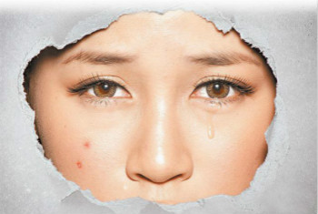 拒當(dāng)「痘花妹」！看痘痘生長(zhǎng)的位置判斷也許是身體出了問(wèn)題